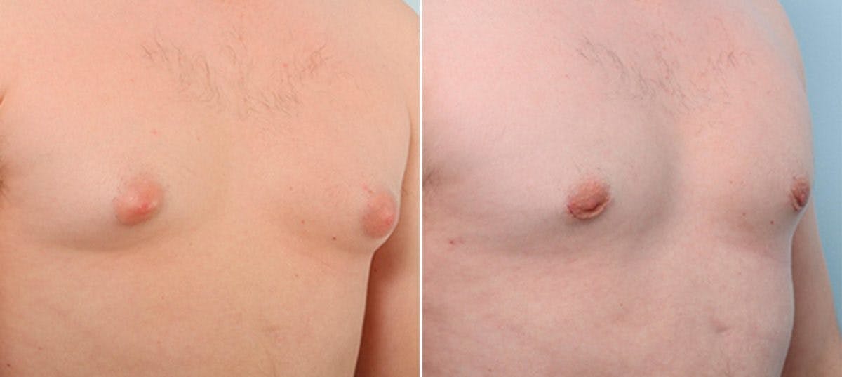 Gynecomastia (Male Breast Reduction) Before & After Photo - Patient 55082391 - Image 3