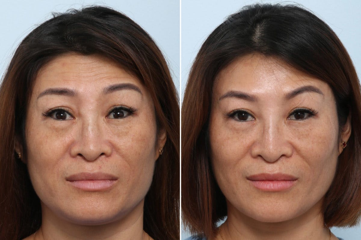 BOTOX® Cosmetic Before & After Gallery - Patient 55082394 - Image 1
