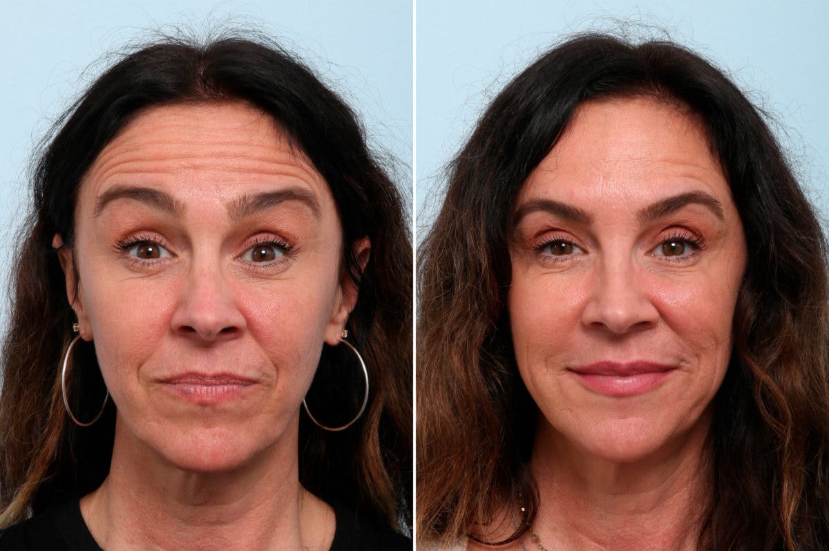 BOTOX® Cosmetic Before & After Gallery - Patient 55082395 - Image 1