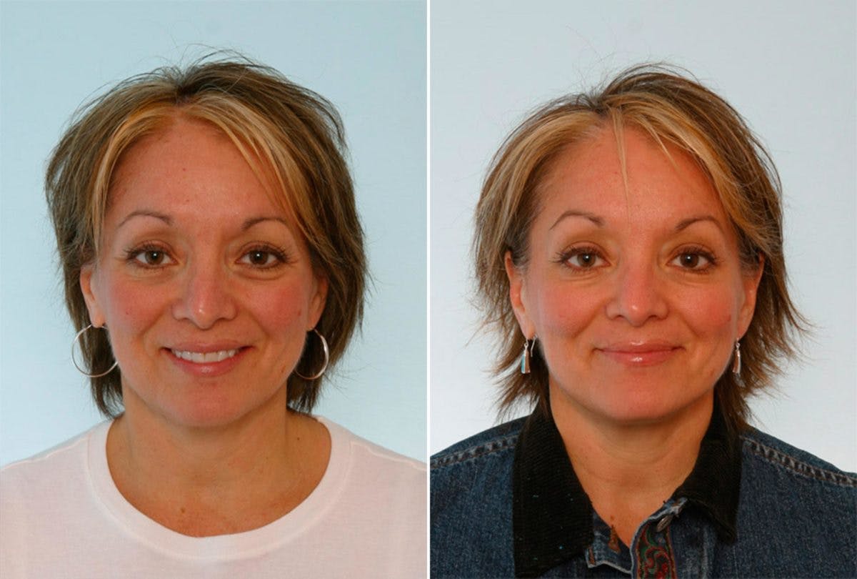 BOTOX® Cosmetic Before & After Gallery - Patient 55082396 - Image 1