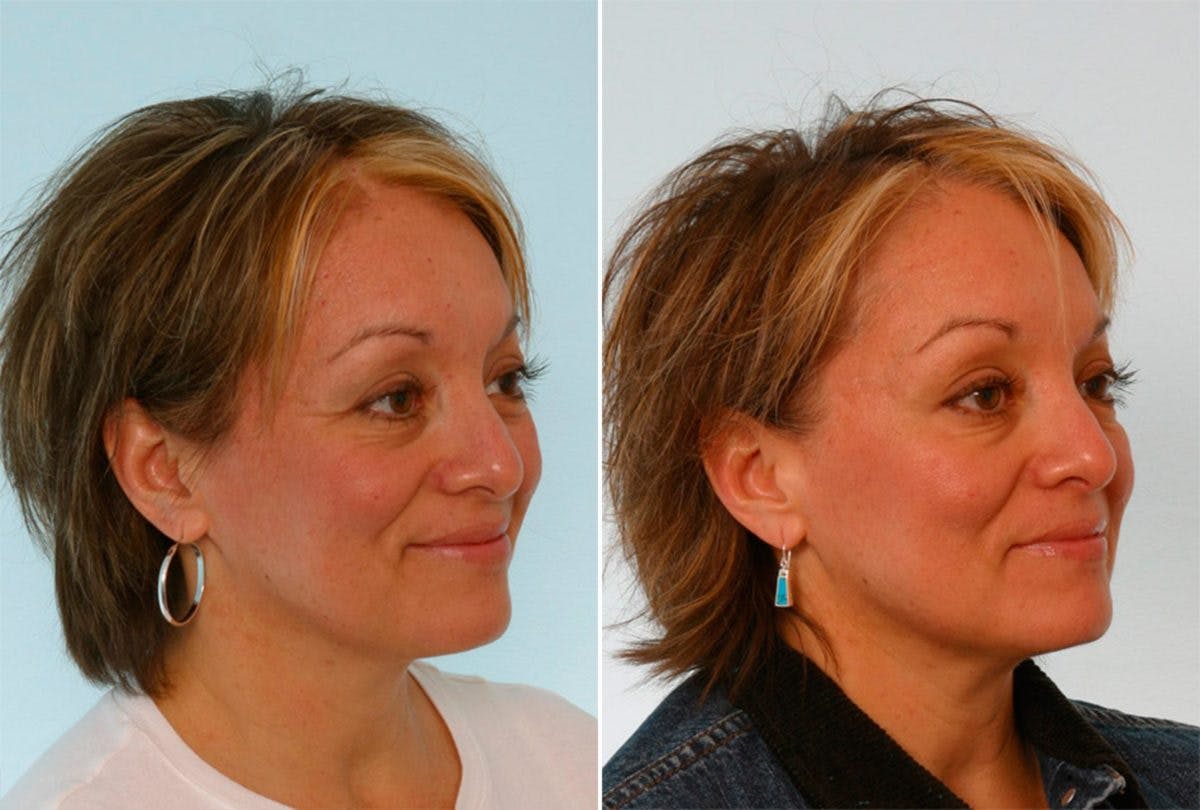 BOTOX® Cosmetic Before & After Gallery - Patient 55082396 - Image 2