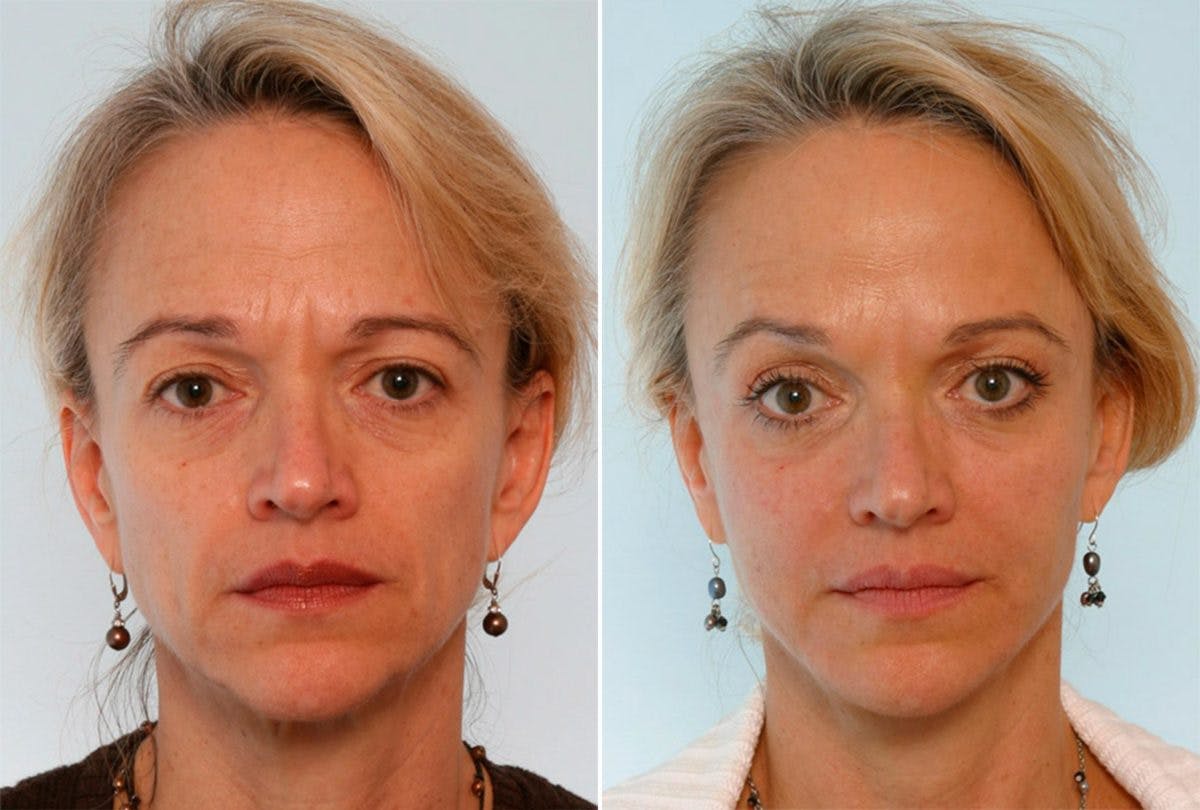 BOTOX® Cosmetic Before & After Gallery - Patient 55082397 - Image 1
