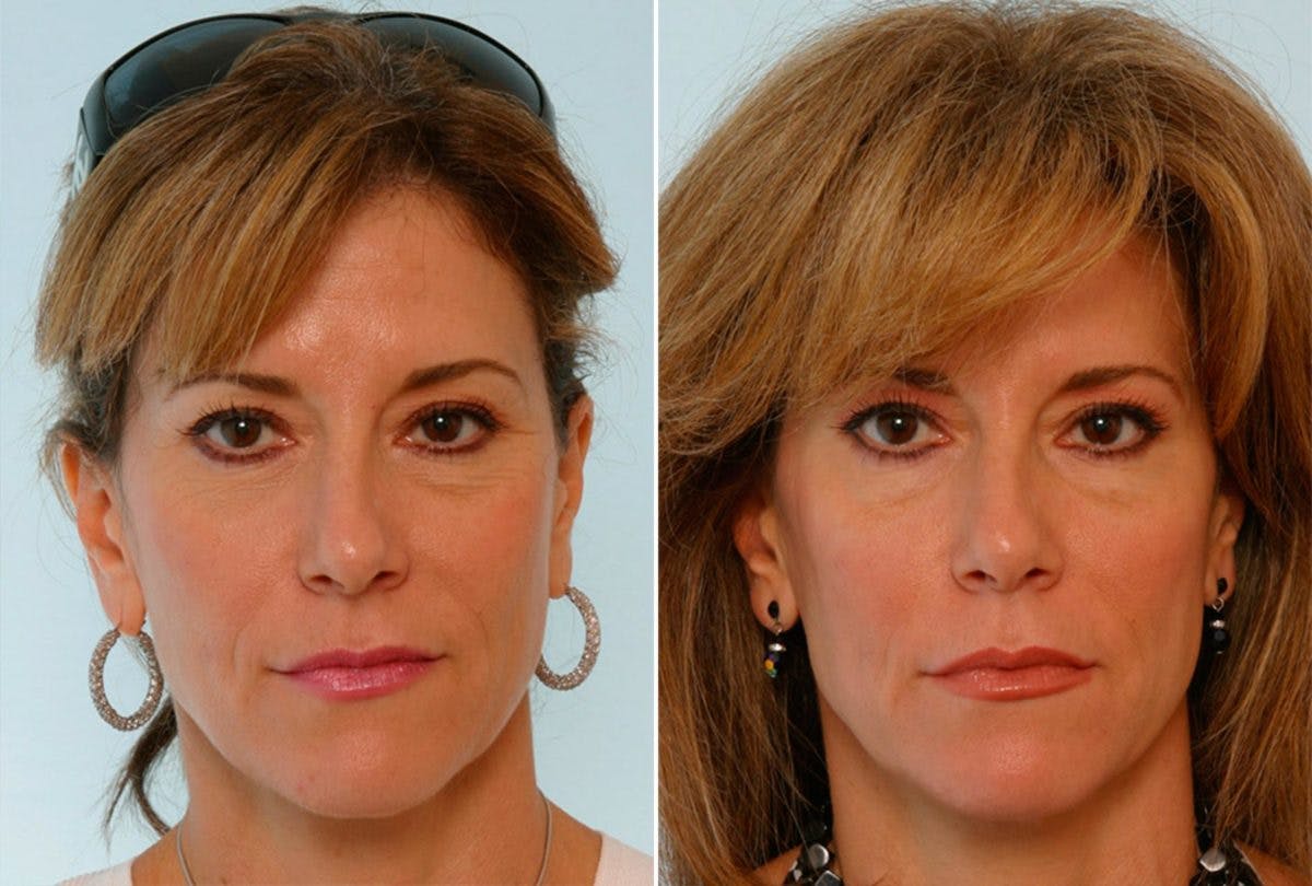 BOTOX® Cosmetic Before & After Gallery - Patient 55082398 - Image 1