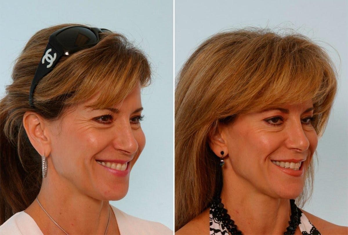 BOTOX® Cosmetic Before & After Gallery - Patient 55082398 - Image 2