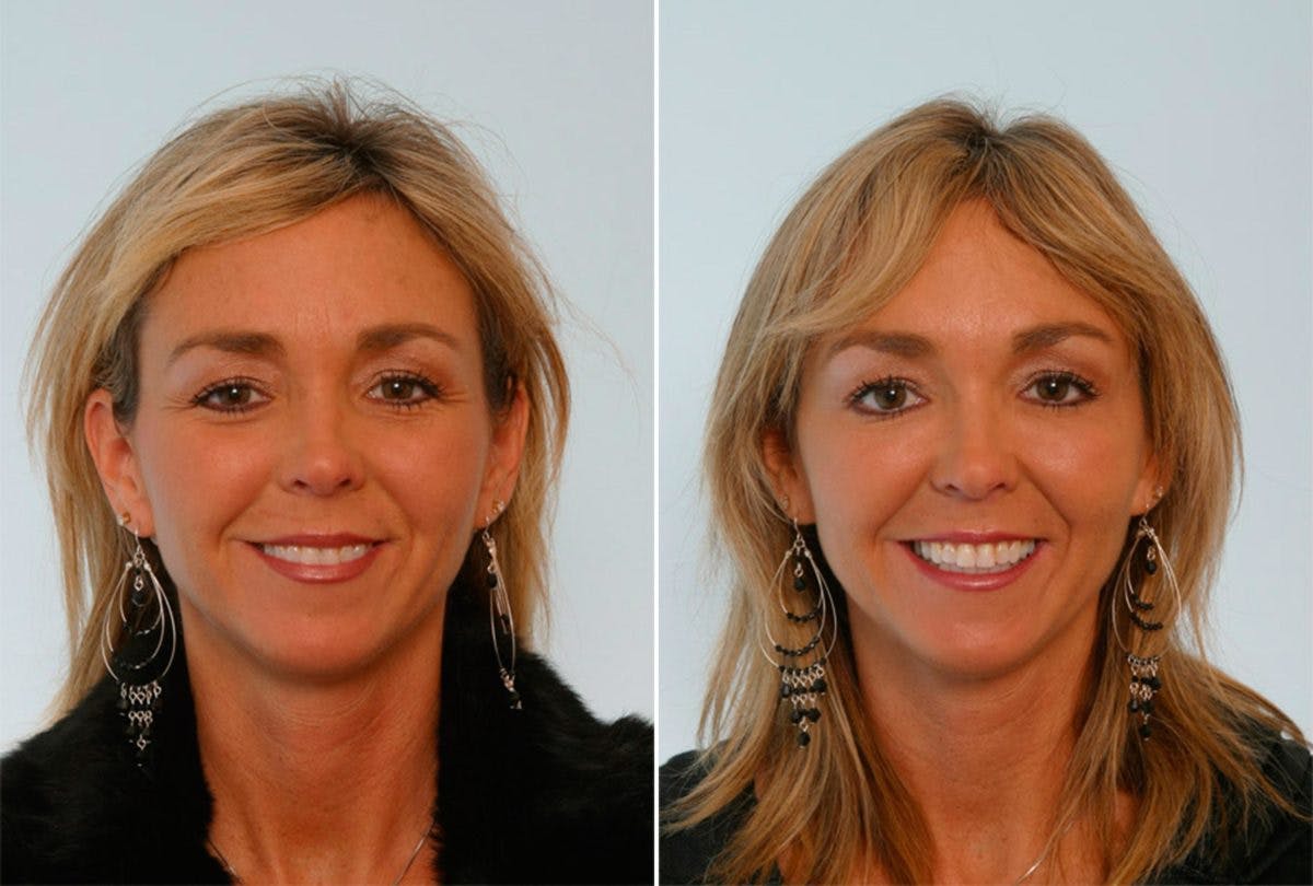 BOTOX® Cosmetic Before & After Gallery - Patient 55082399 - Image 1