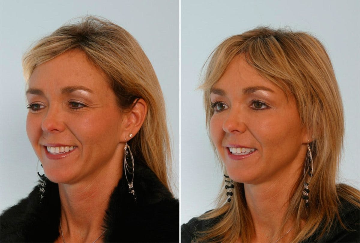 BOTOX® Cosmetic Before & After Gallery - Patient 55082399 - Image 2