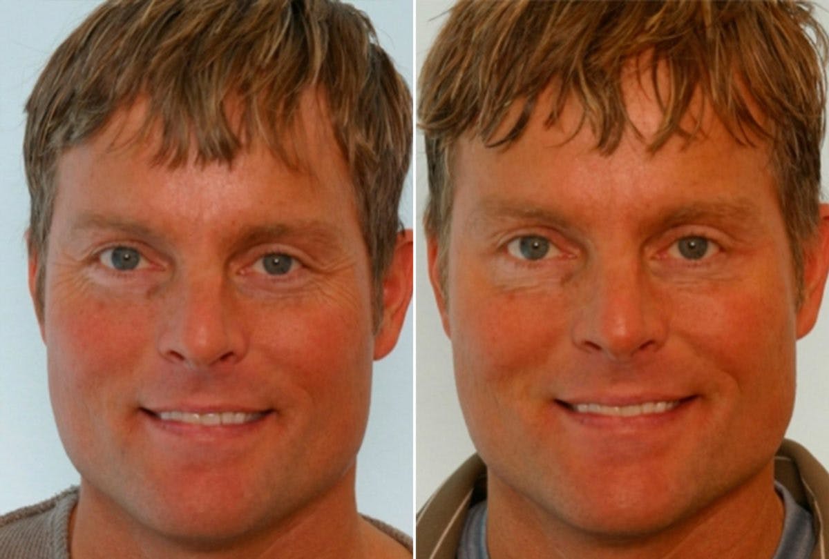 BOTOX® Cosmetic Before & After Gallery - Patient 55082400 - Image 1