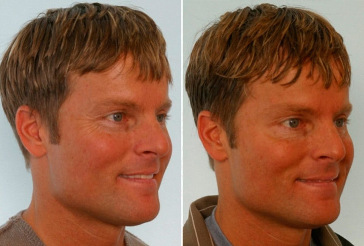BOTOX® Cosmetic Before & After Photo - Patient 55082400 - Image 2