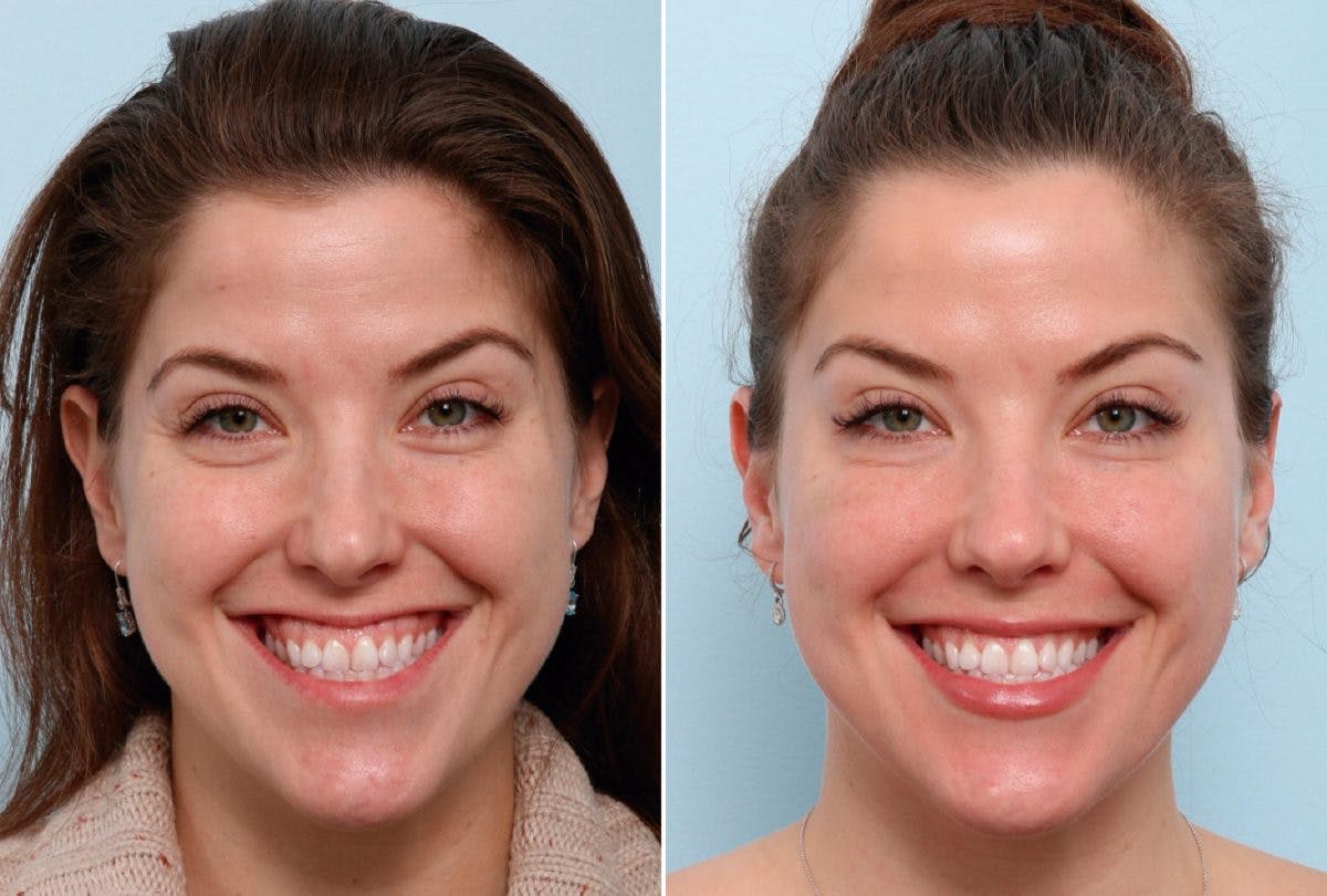 BOTOX® Cosmetic Before & After Gallery - Patient 55082401 - Image 1