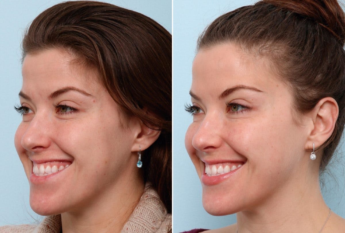 BOTOX® Cosmetic Before & After Gallery - Patient 55082401 - Image 2
