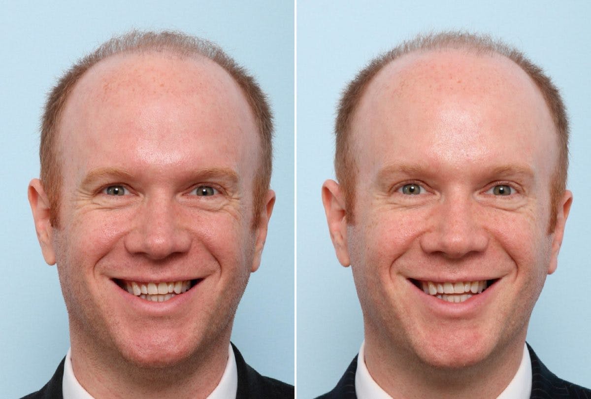 BOTOX® Cosmetic Before & After Gallery - Patient 55082402 - Image 2