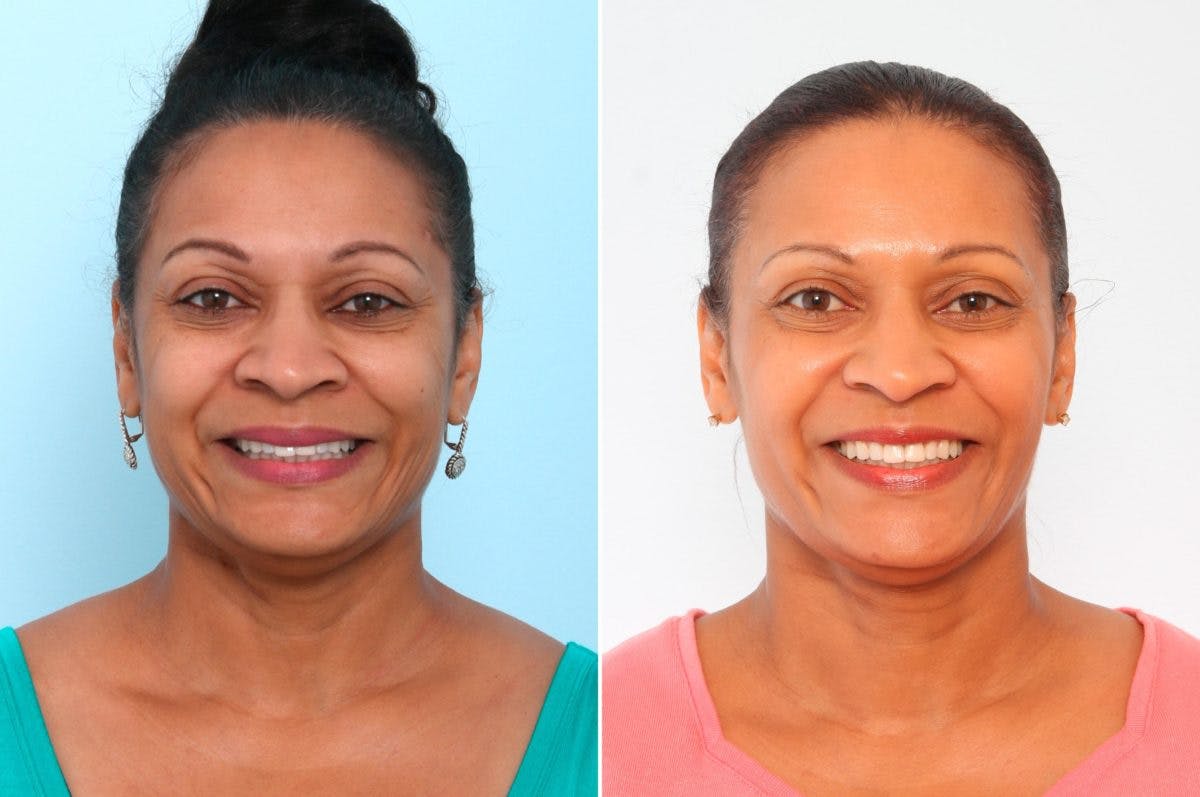 BOTOX® Cosmetic Before & After Gallery - Patient 55082403 - Image 1