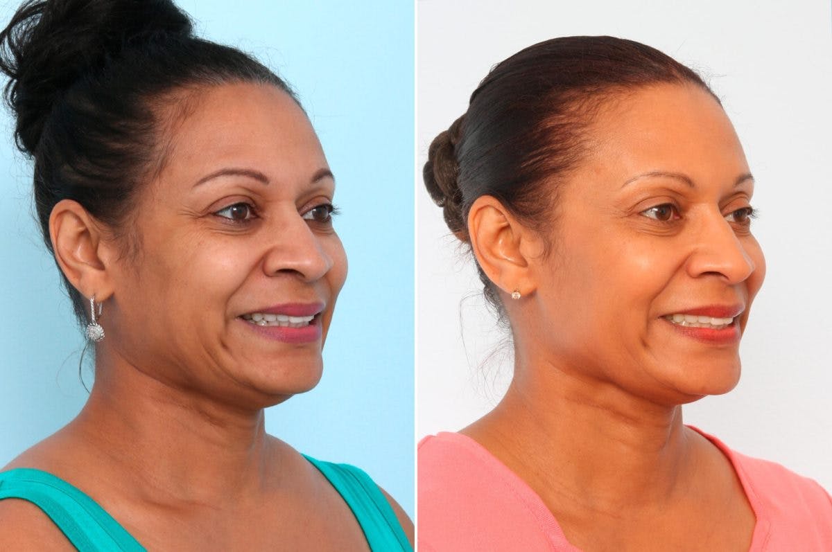 BOTOX® Cosmetic Before & After Gallery - Patient 55082403 - Image 2
