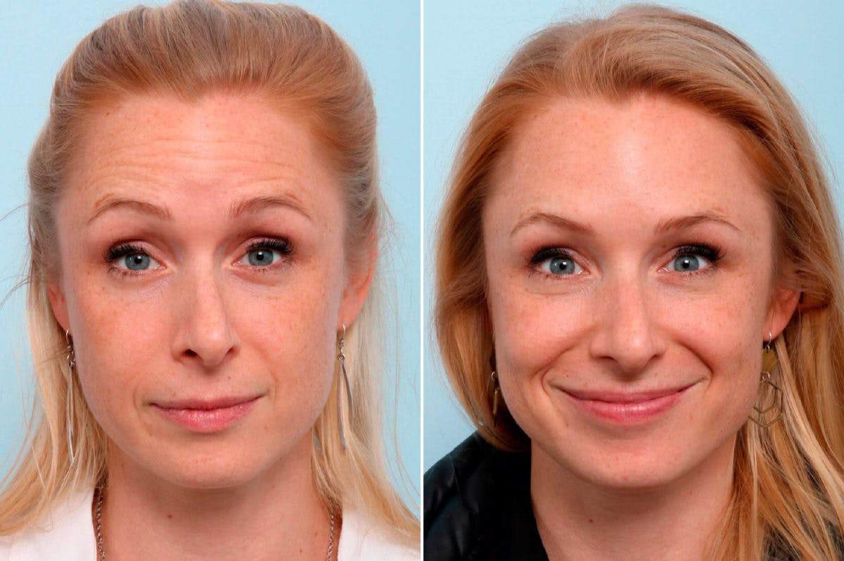 BOTOX® Cosmetic Before & After Gallery - Patient 55082404 - Image 1