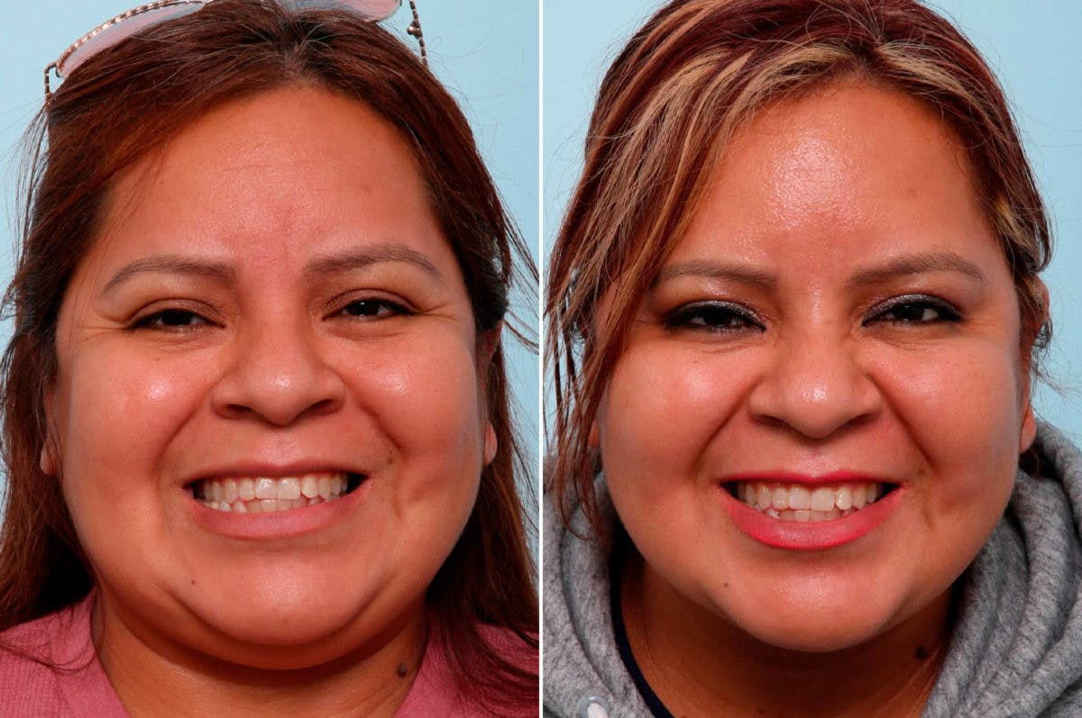 BOTOX® Cosmetic Before & After Gallery - Patient 55082405 - Image 1