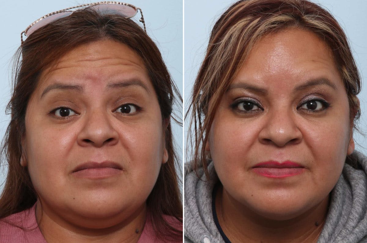 BOTOX® Cosmetic Before & After Gallery - Patient 55082405 - Image 2