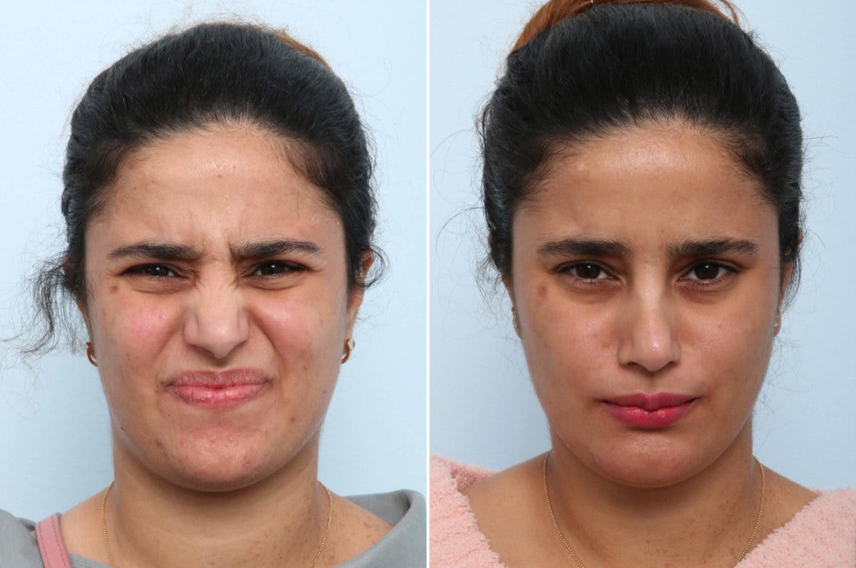 BOTOX® Cosmetic Before & After Gallery - Patient 55082407 - Image 1