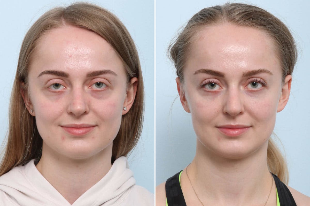 BOTOX® Cosmetic Before & After Gallery - Patient 55082408 - Image 1