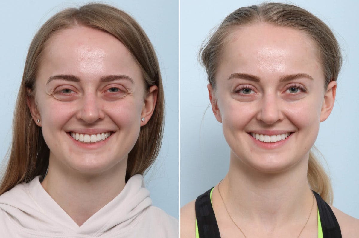 BOTOX® Cosmetic Before & After Photo - Patient 55082408 - Image 2