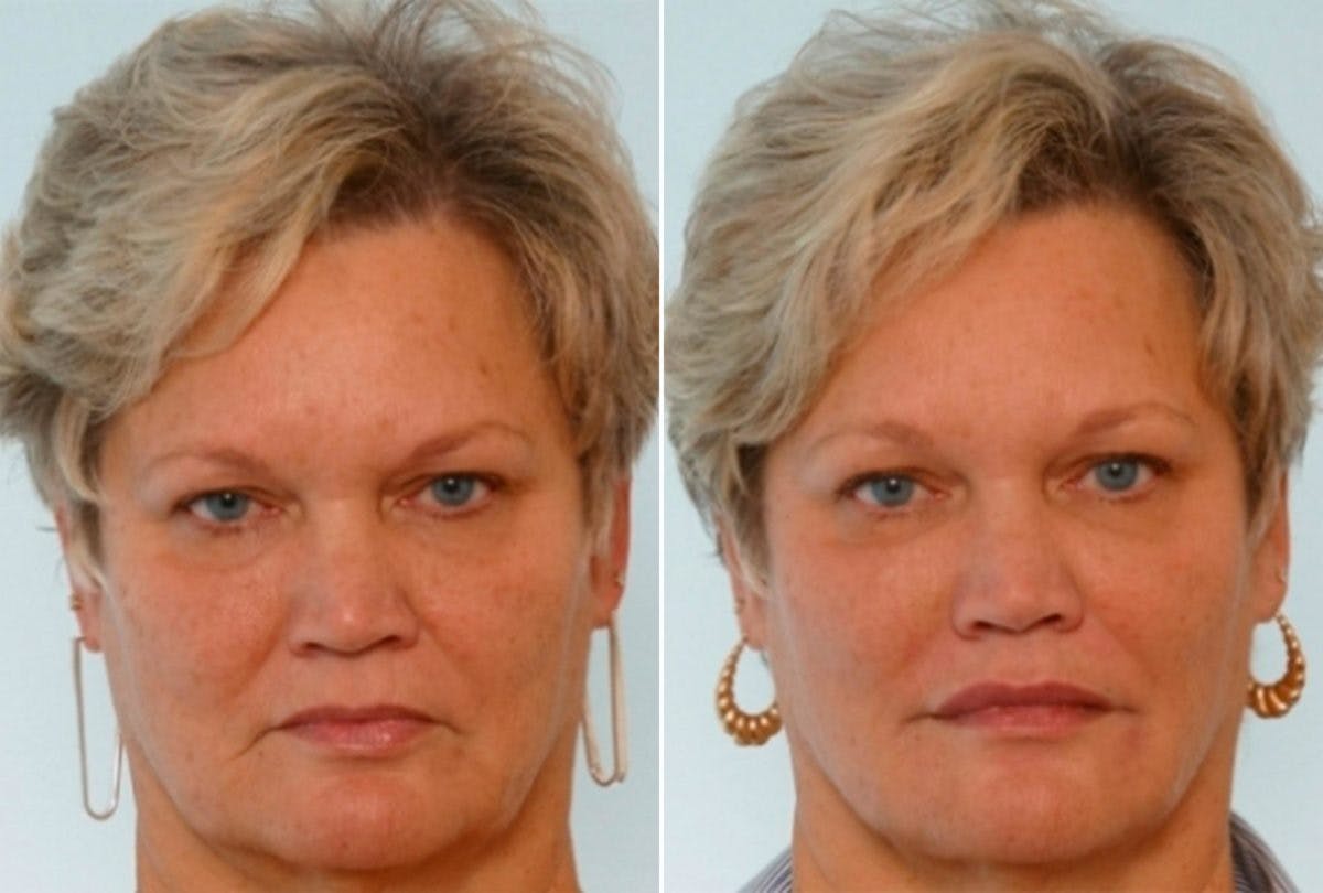 BOTOX® Cosmetic Before & After Gallery - Patient 55082409 - Image 1