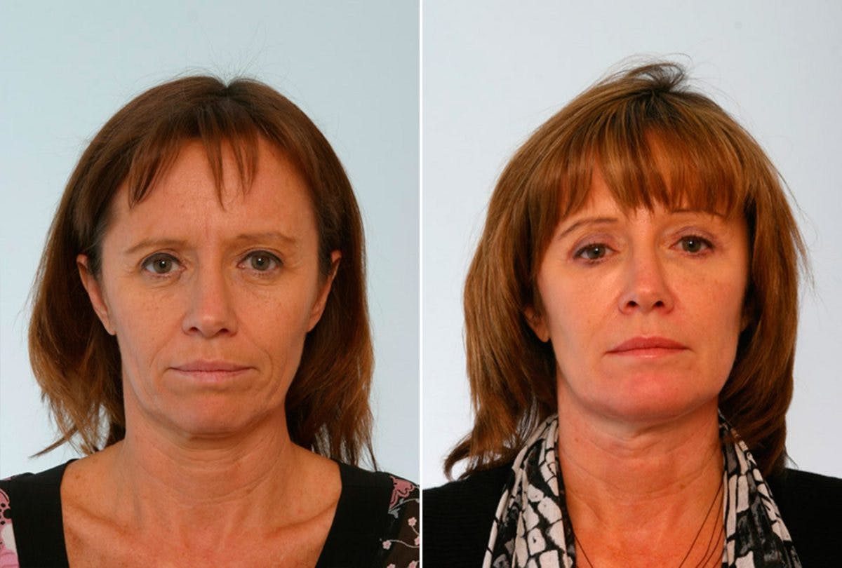 Brow Lift Before & After Photo - Patient 55104461 - Image 1