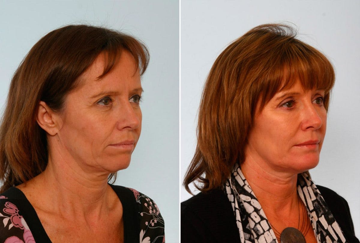 Brow Lift Before & After Photo - Patient 55104461 - Image 2