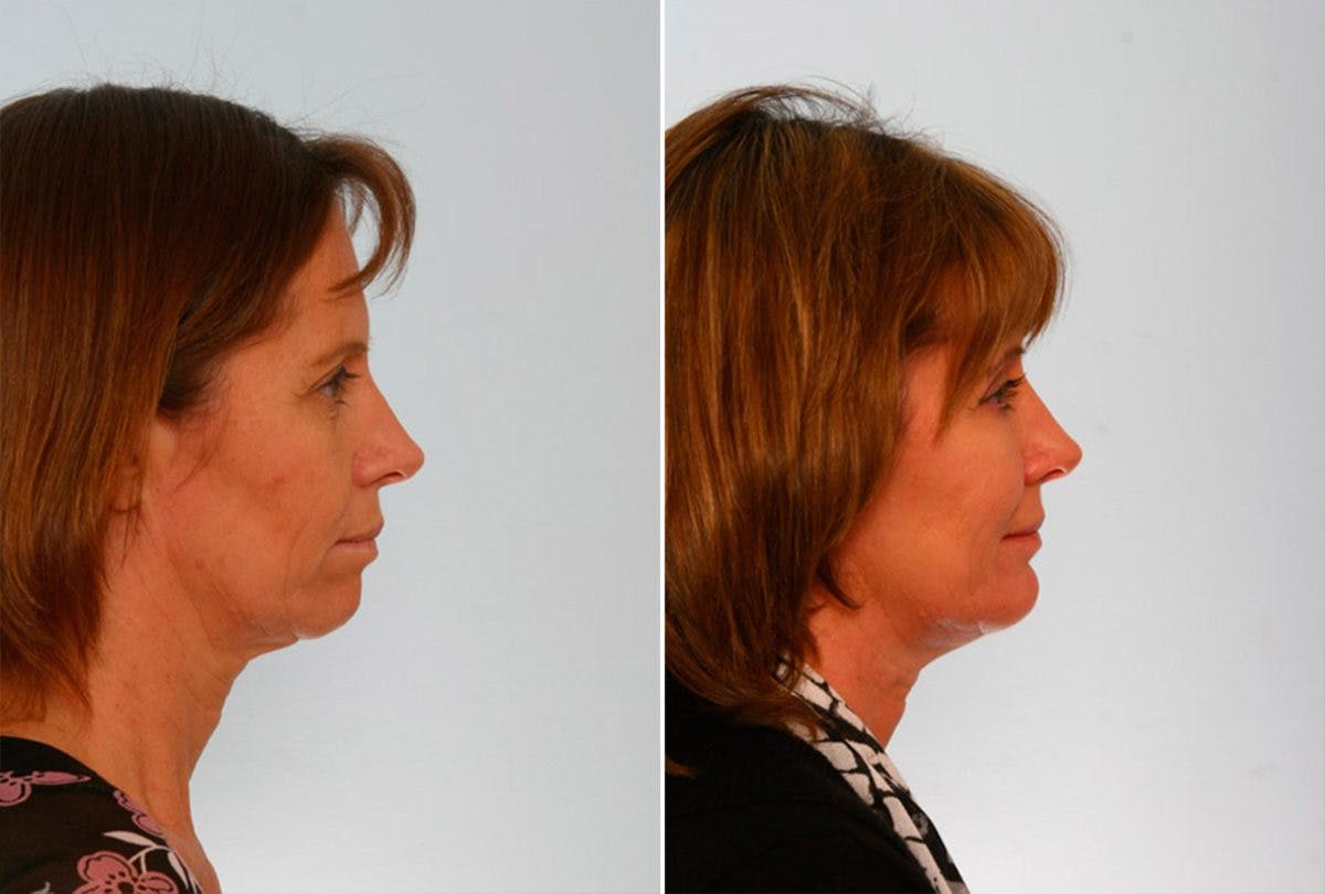 Brow Lift Before & After Gallery - Patient 55104461 - Image 3