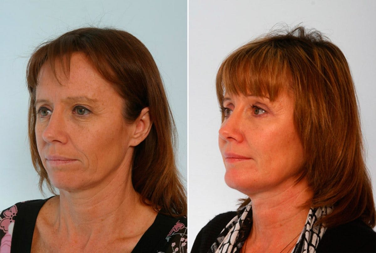 Brow Lift Before & After Photo - Patient 55104461 - Image 4