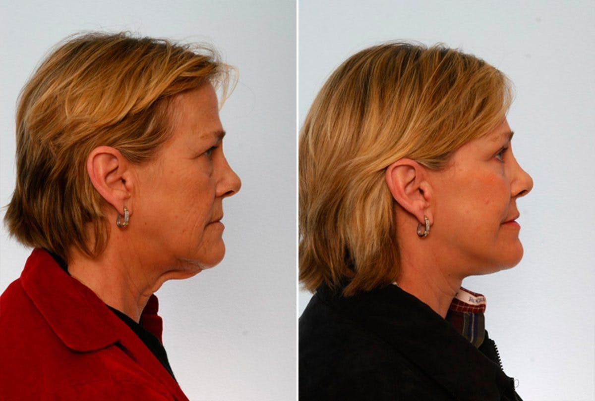 Brow Lift Before & After Gallery - Patient 55104462 - Image 3