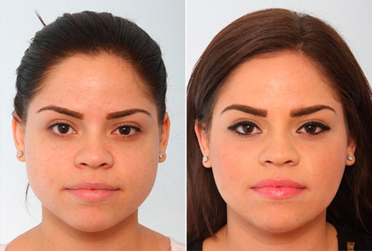 Buccal Fat Pad Removal Before & After Gallery - Patient 55104467 - Image 1
