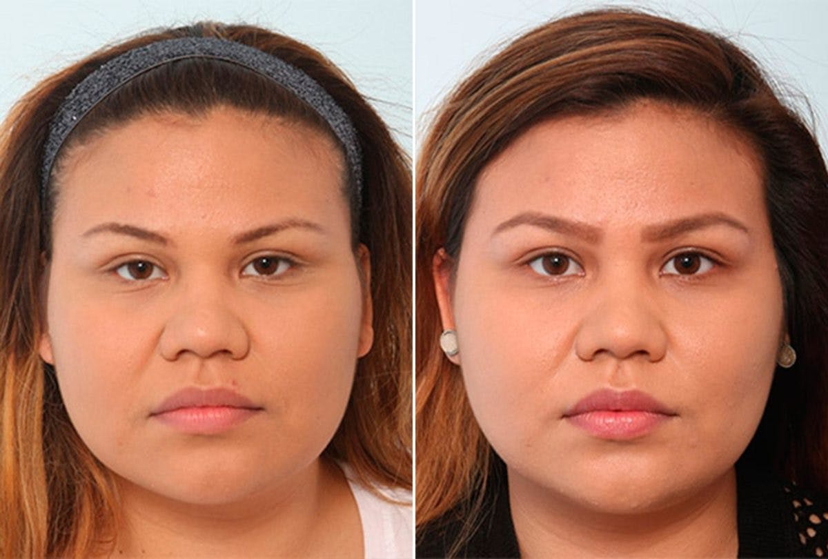 Buccal Fat Pad Removal Before & After Gallery - Patient 55104468 - Image 1
