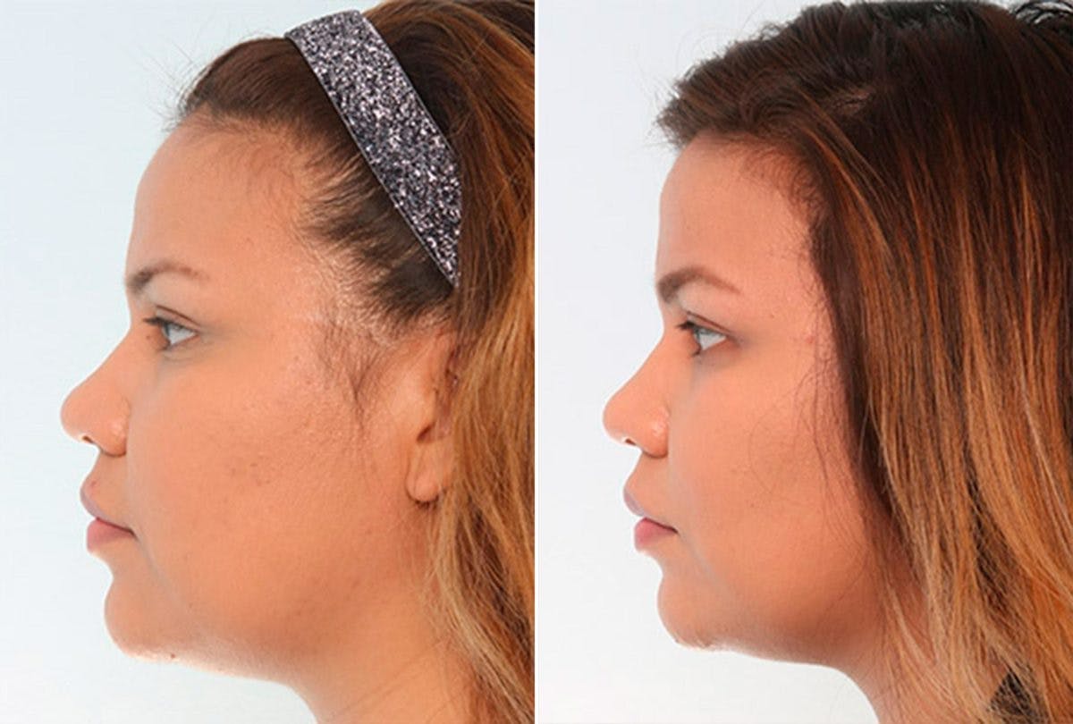 Buccal Fat Pad Removal Before & After Photo - Patient 55104468 - Image 3