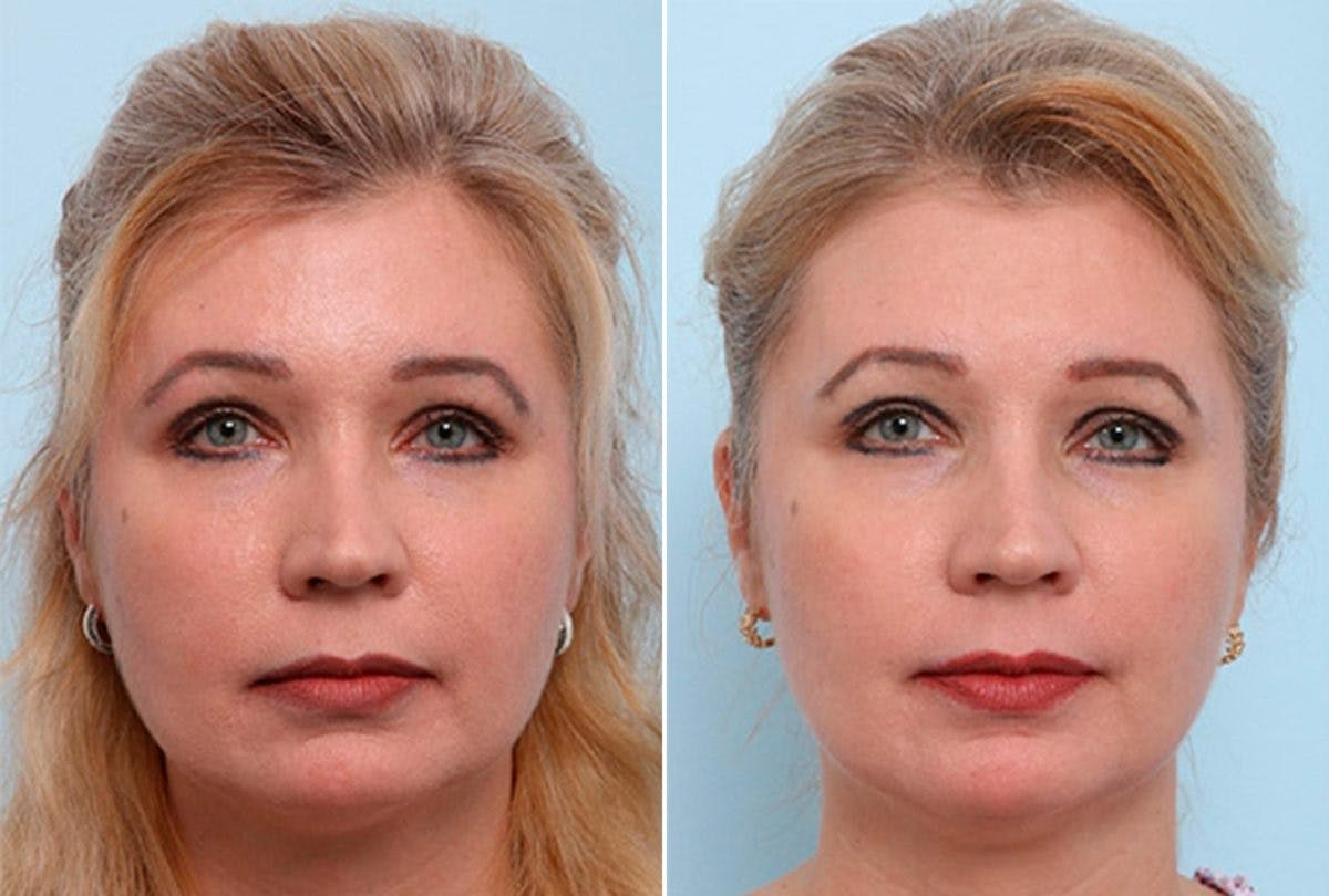 Buccal Fat Pad Removal Before & After Gallery - Patient 55104469 - Image 1