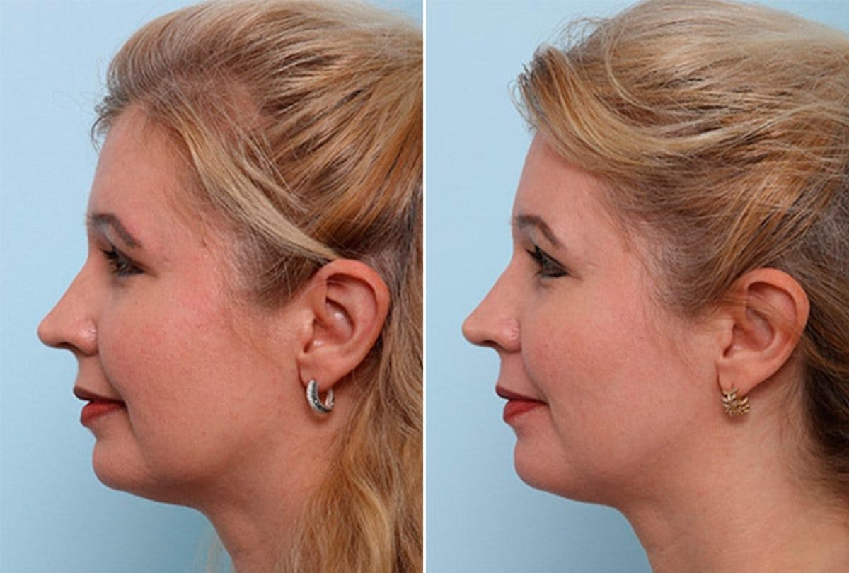 Buccal Fat Pad Removal Before & After Gallery - Patient 55104469 - Image 3