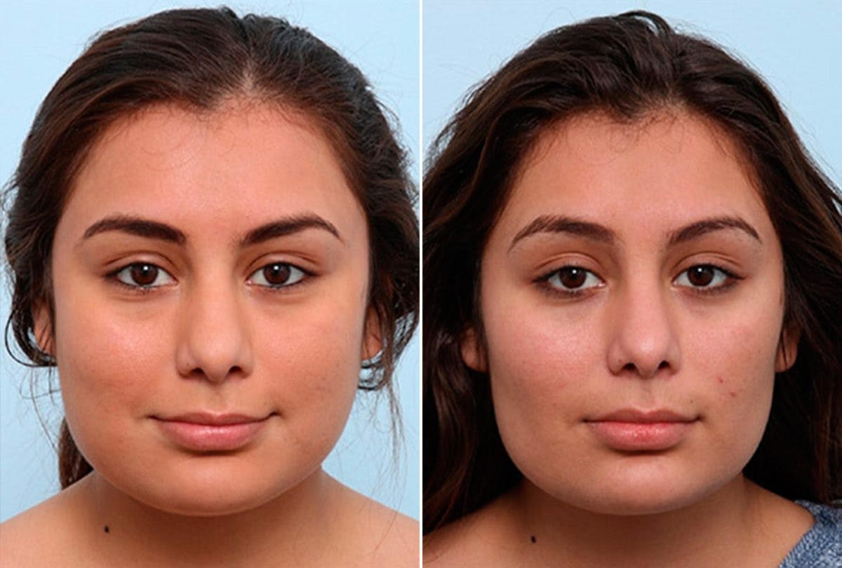 Buccal Fat Pad Removal Before & After Gallery - Patient 55104470 - Image 1