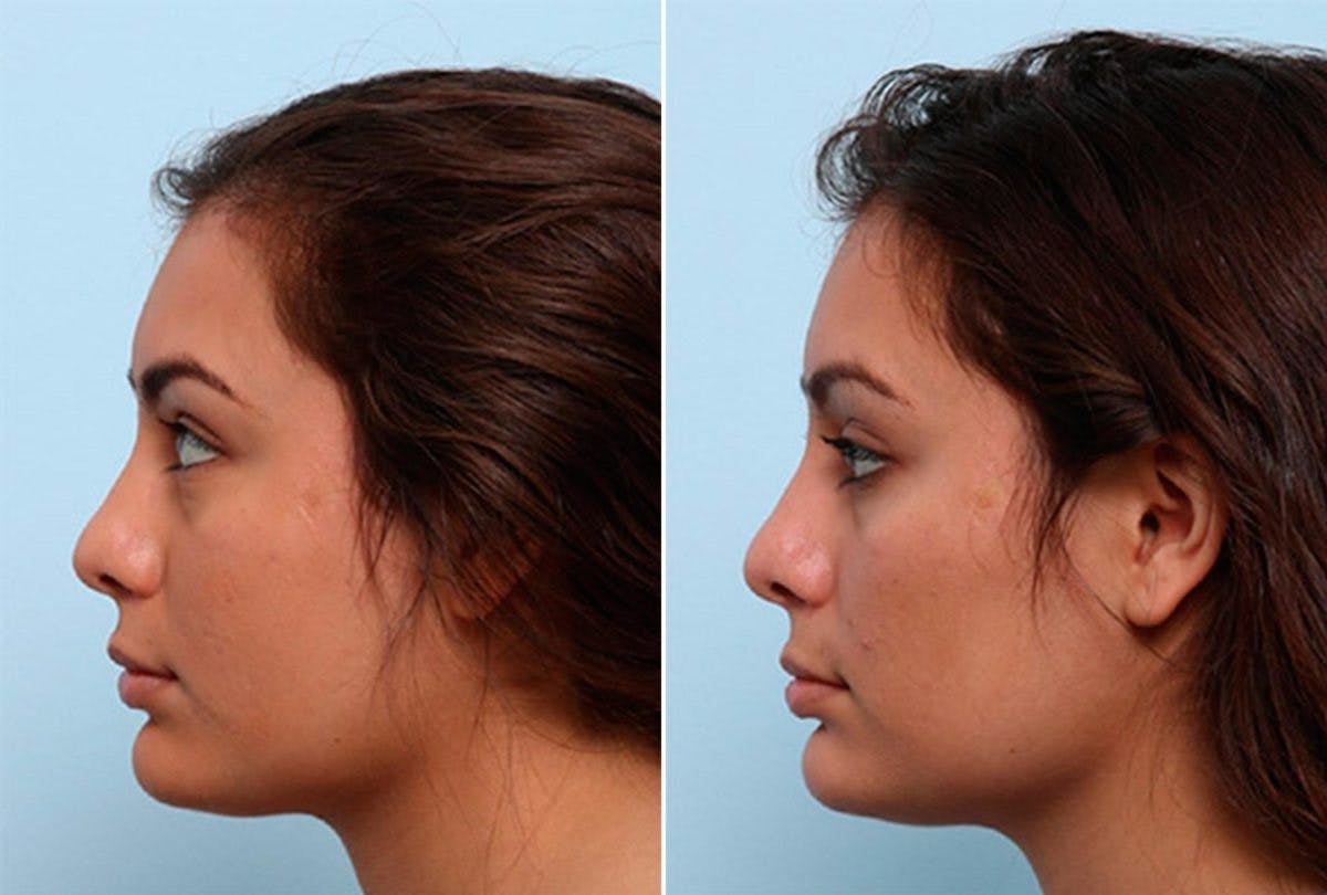 Buccal Fat Pad Removal Before & After Gallery - Patient 55104470 - Image 3