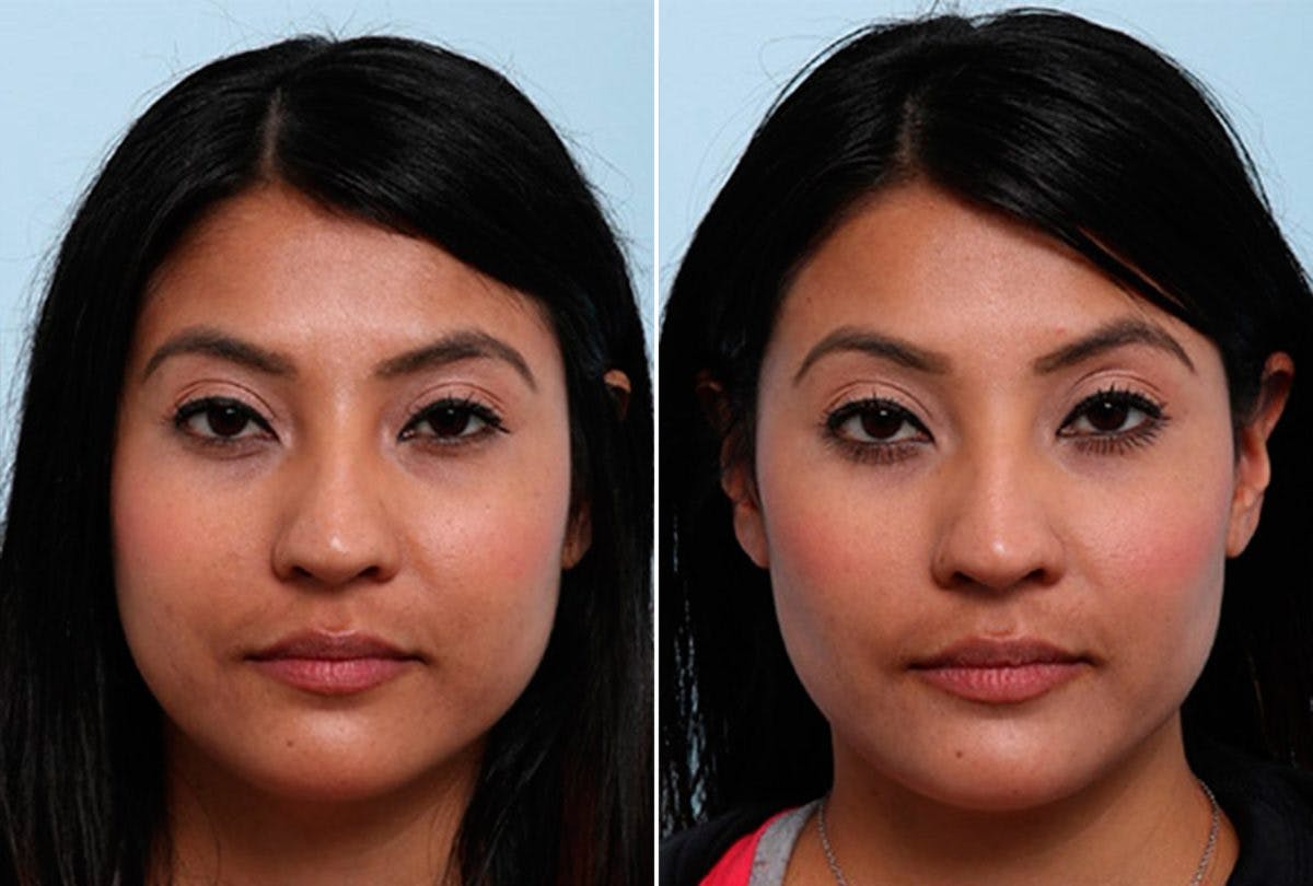 Buccal Fat Pad Removal Before & After Photo - Patient 55104472 - Image 1