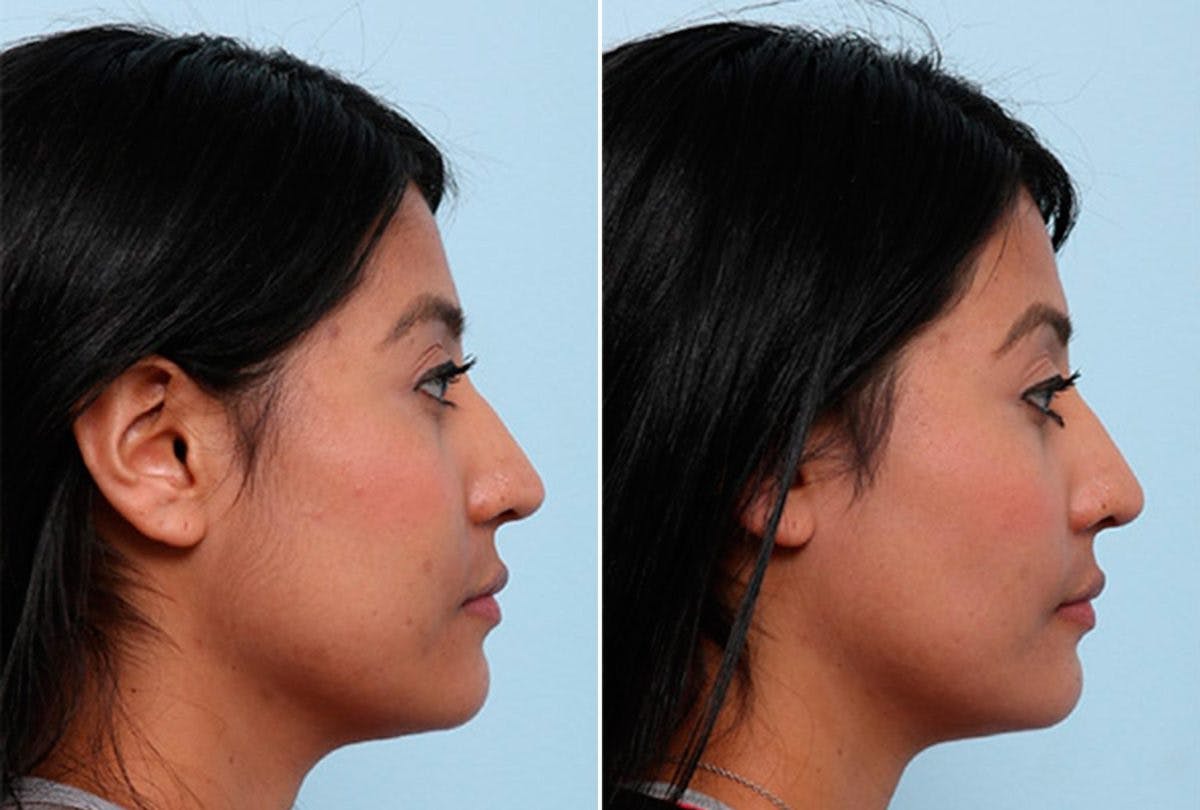 Buccal Fat Pad Removal Before & After Photo - Patient 55104472 - Image 2