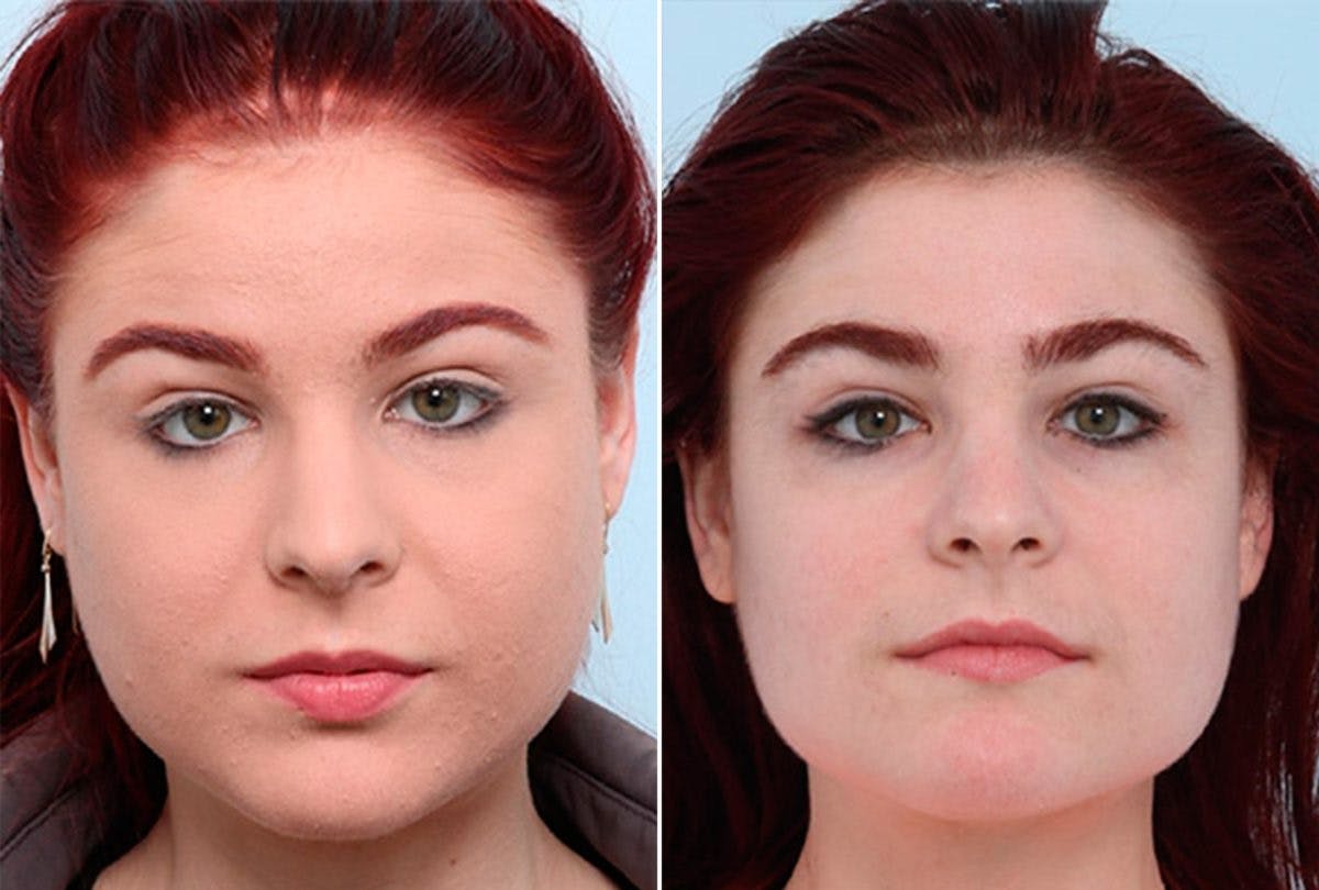 Buccal Fat Pad Removal Before & After Gallery - Patient 55104473 - Image 1