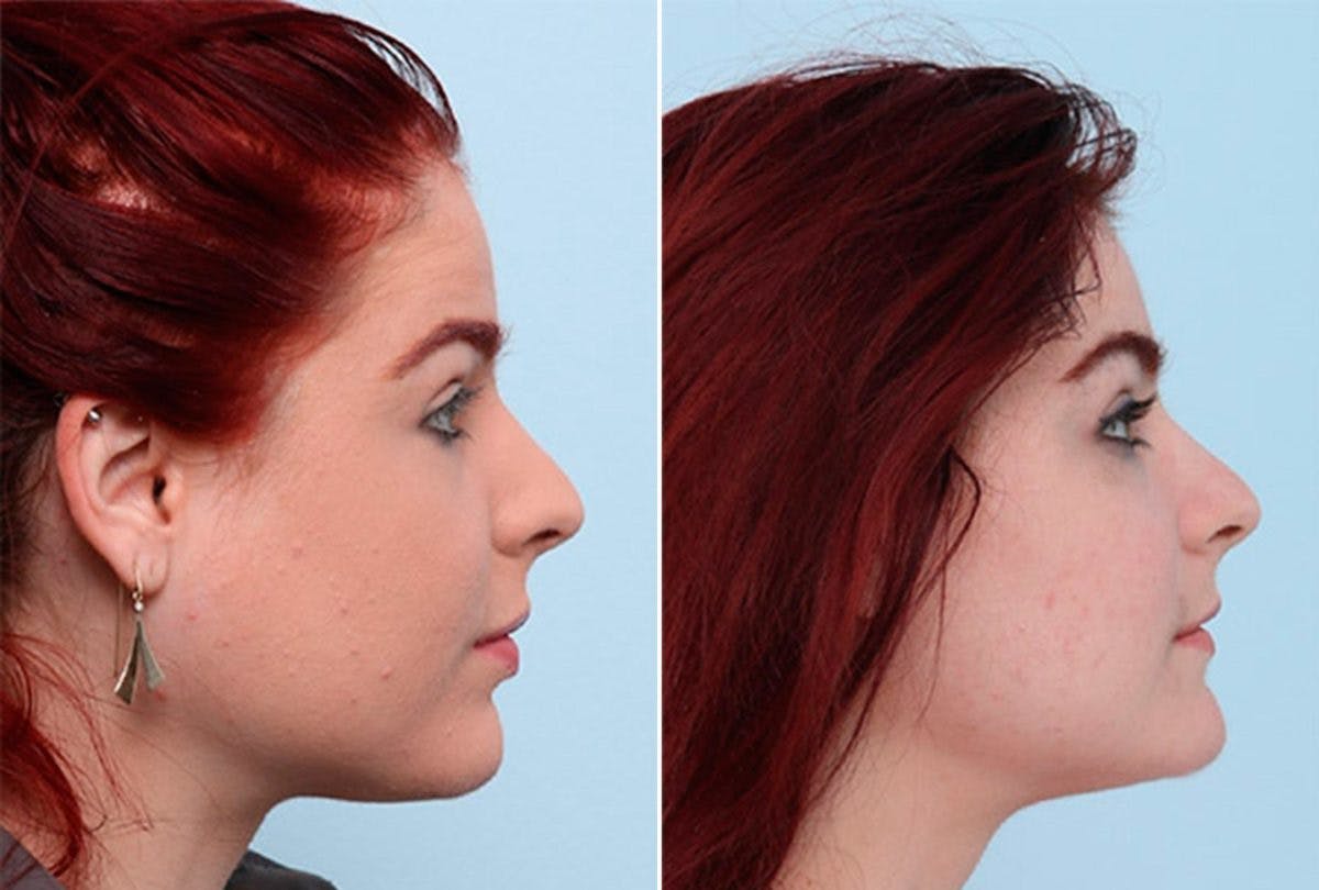 Buccal Fat Pad Removal Before & After Gallery - Patient 55104473 - Image 2
