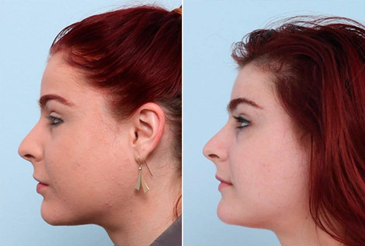 Buccal Fat Pad Removal Before & After Gallery - Patient 55104473 - Image 3