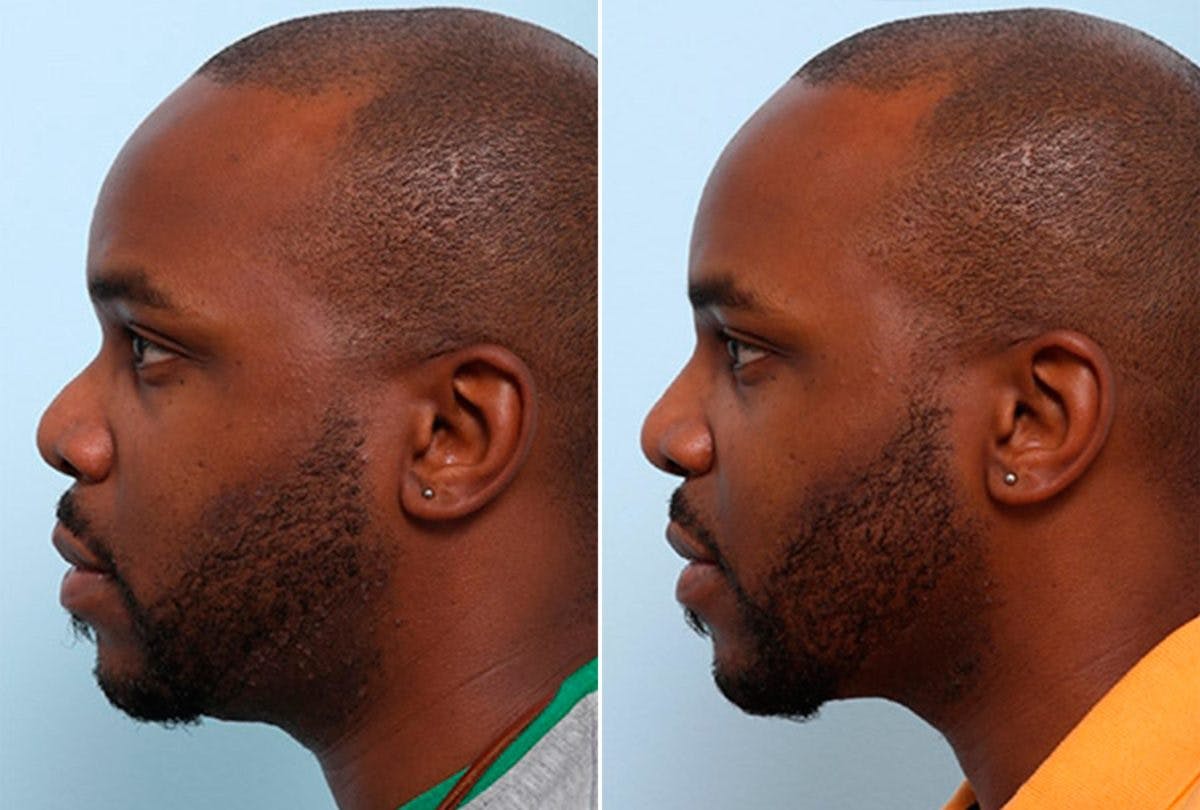 Buccal Fat Pad Removal Before & After Photo - Patient 55104474 - Image 3
