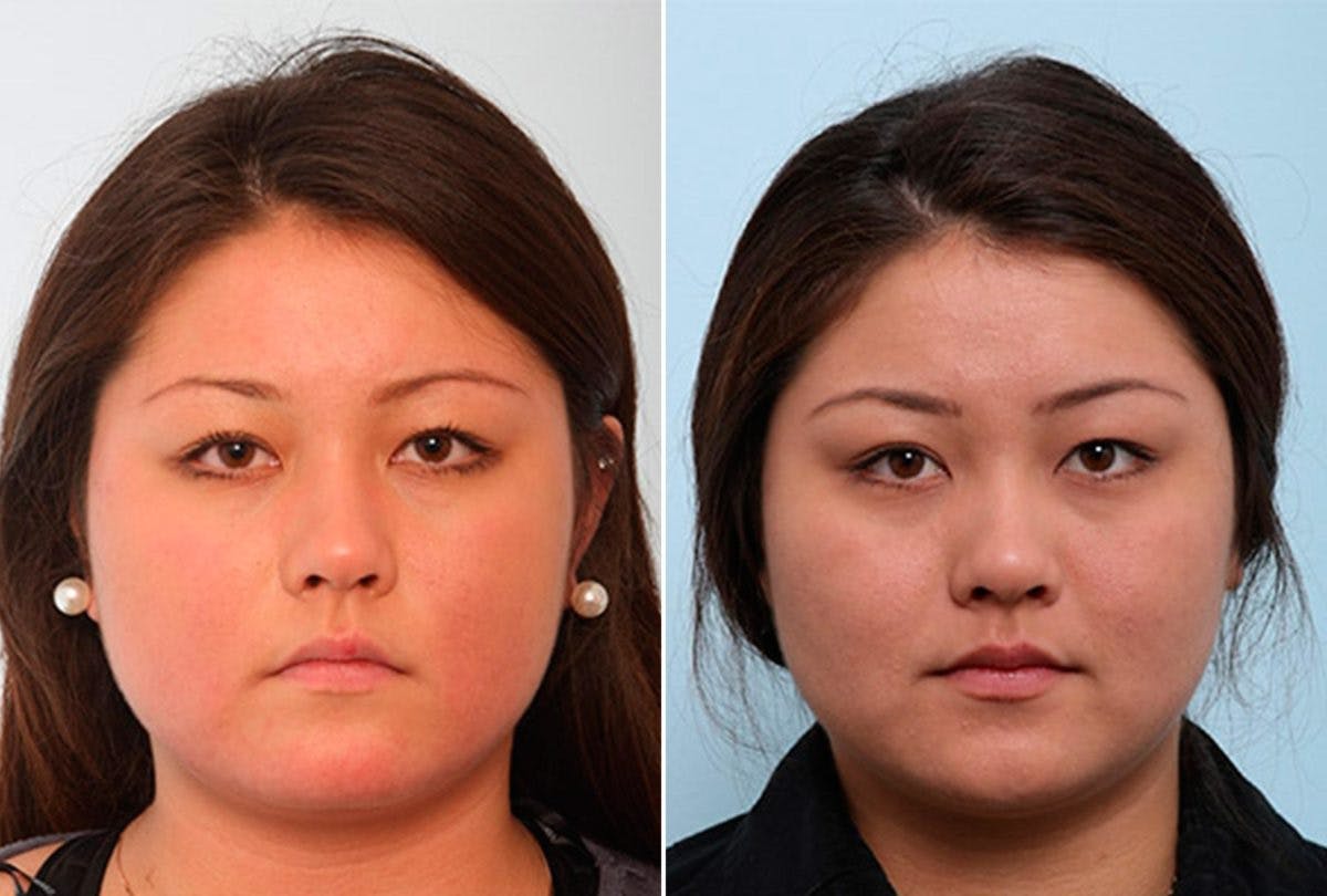 Buccal Fat Pad Removal Before & After Gallery - Patient 55104475 - Image 1