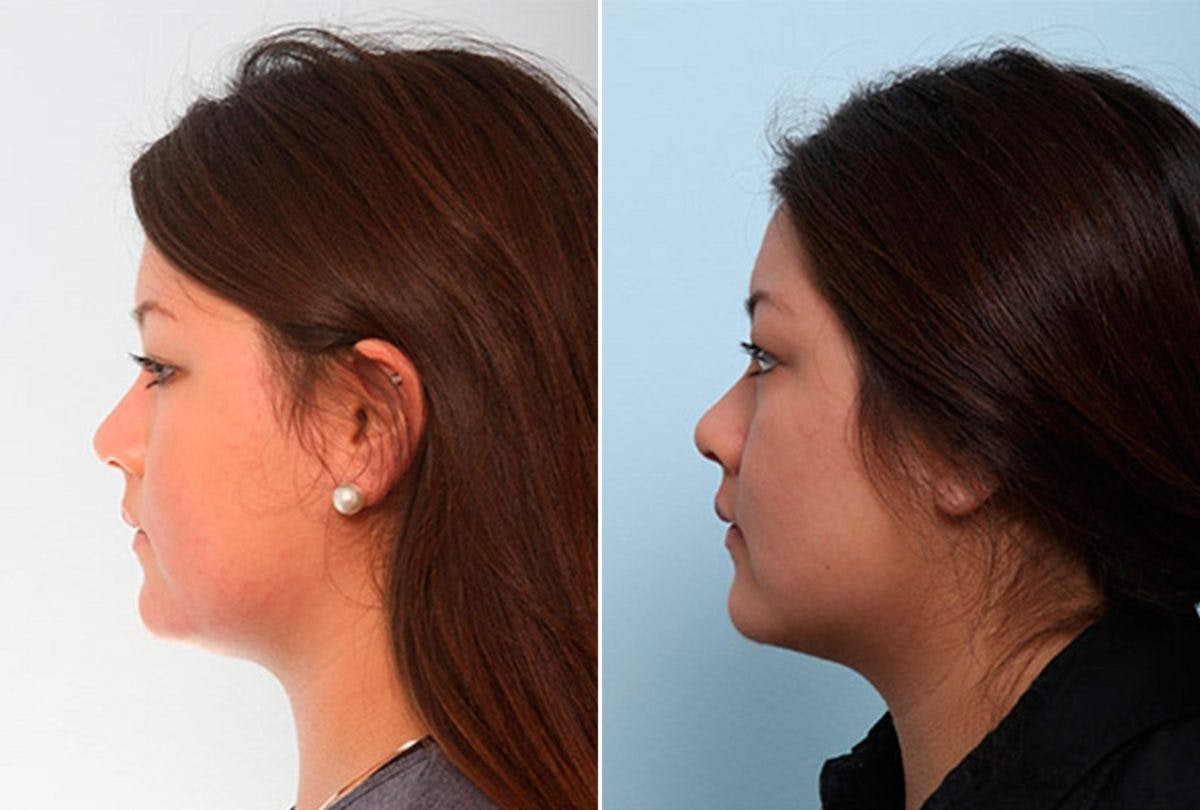 Buccal Fat Pad Removal Before & After Gallery - Patient 55104475 - Image 2