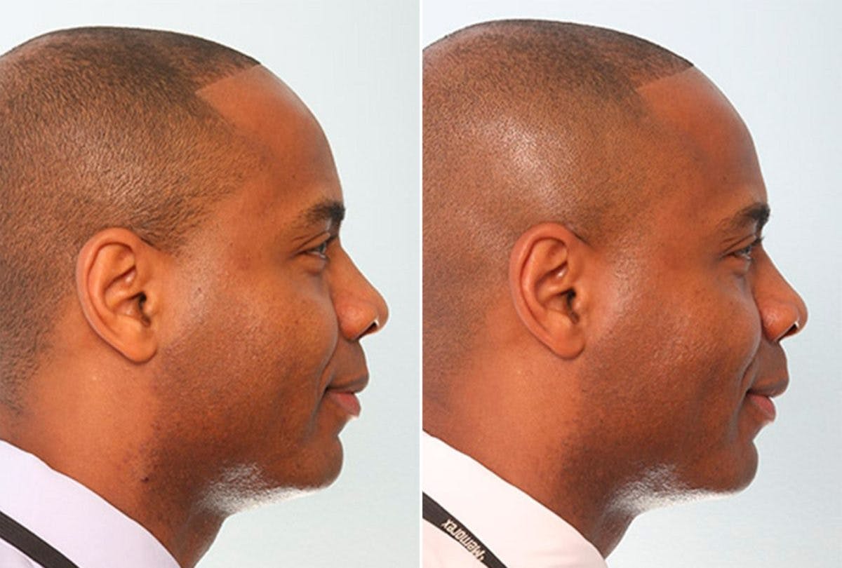Buccal Fat Pad Removal Before & After Photo - Patient 55104476 - Image 2