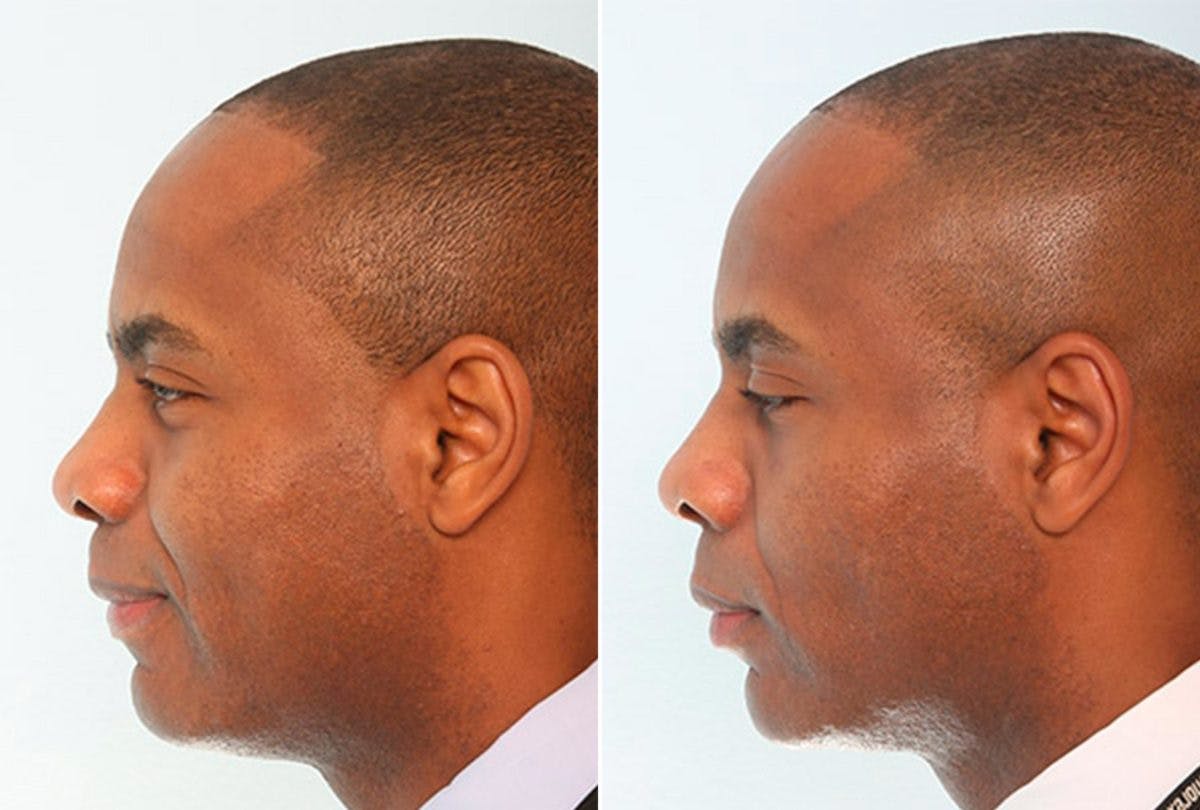 Buccal Fat Pad Removal Before & After Photo - Patient 55104476 - Image 3