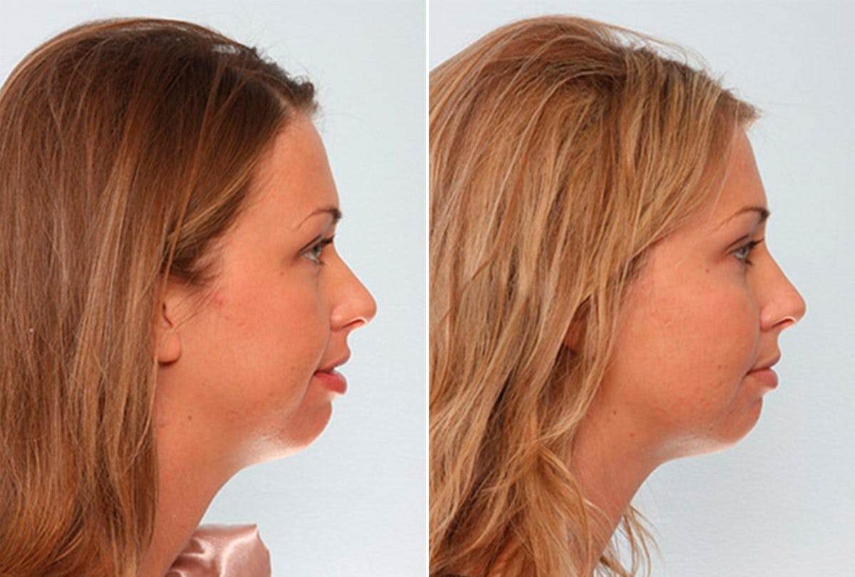 Buccal Fat Pad Removal Before & After Gallery - Patient 55104477 - Image 2