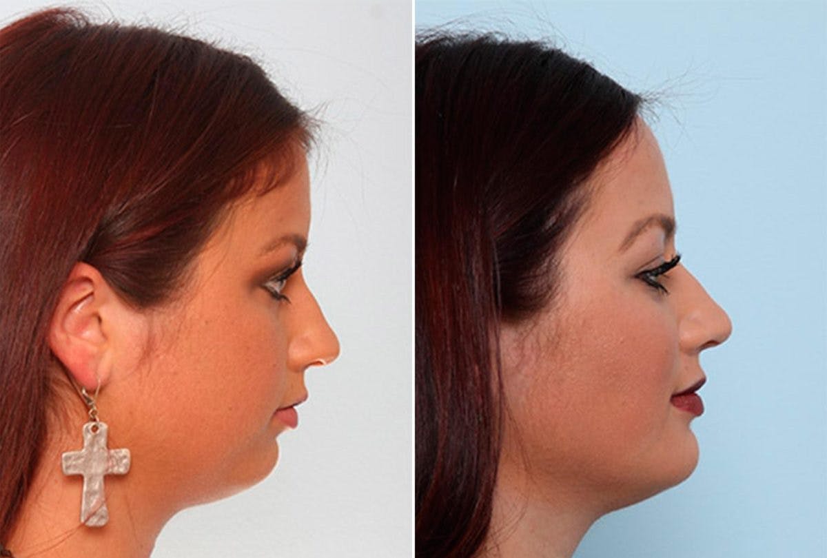 Buccal Fat Pad Removal Before & After Photo - Patient 55104478 - Image 2