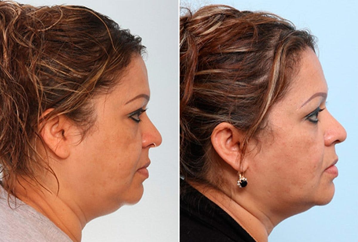 Buccal Fat Pad Removal Before & After Gallery - Patient 55104480 - Image 2