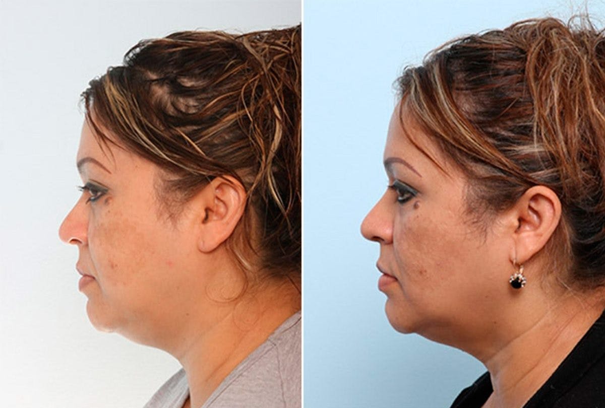 Buccal Fat Pad Removal Before & After Gallery - Patient 55104480 - Image 3